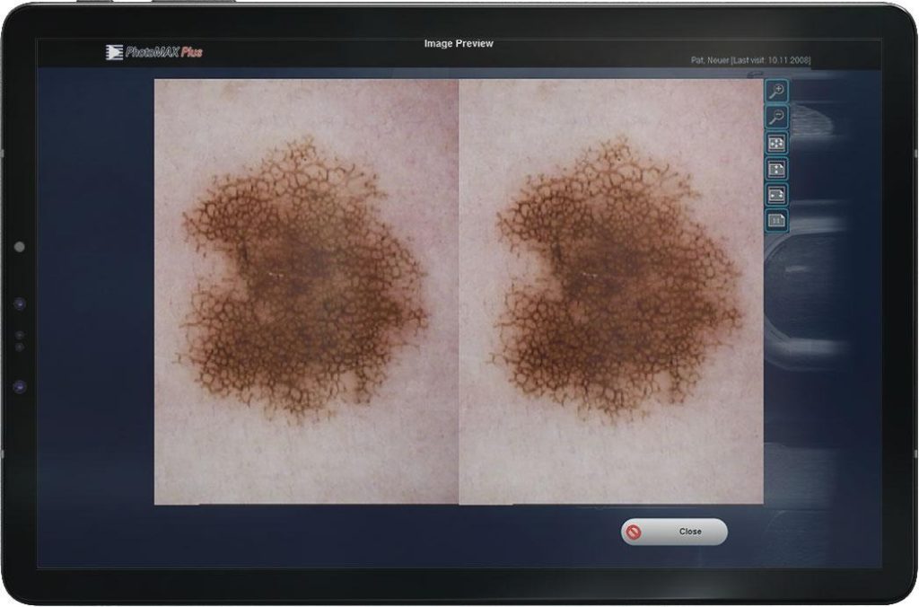 side by side mole comparison