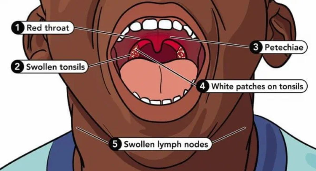Untreated Strep Throat – Hidden Risks You Should Never Ignore!