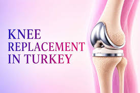 Knee Replacement in Turkey for Americans: Costs, Recovery and Treatment Planning