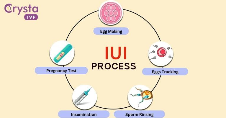 IUI Treatment: How is it Timed and Carried Out?