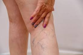 Understanding the Risks of Untreated Collapsed Veins