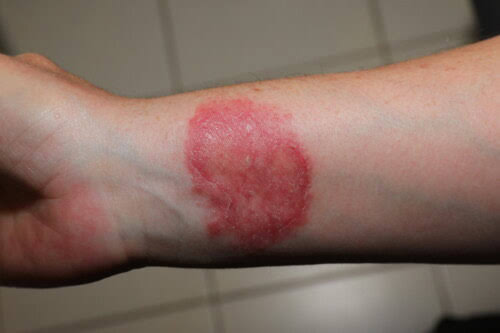 Can Dog Allergies Transfer to Humans? 5 Zoonotic Skin Conditions Every Pet Owner Must Know