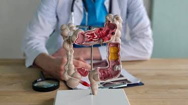 Colorectal Cancer Is Striking Indians Younger Than Ever